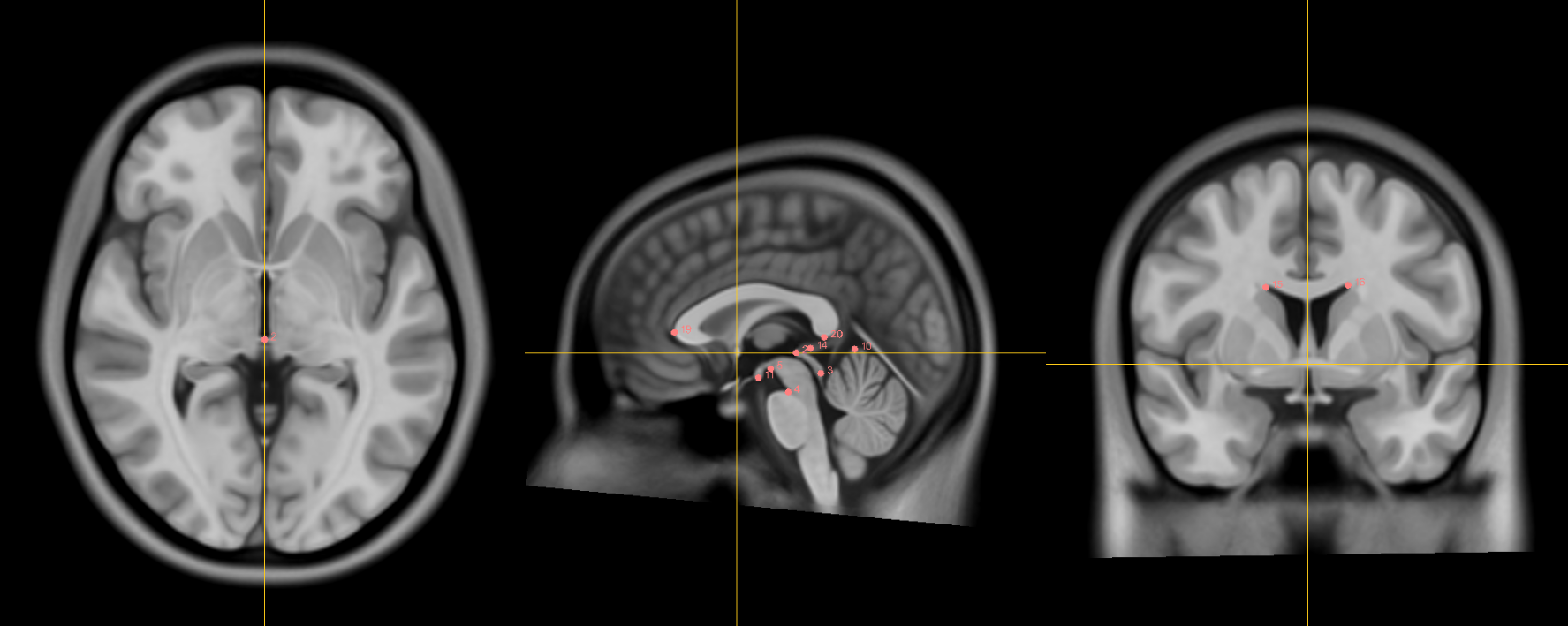 !The anterior commissure.