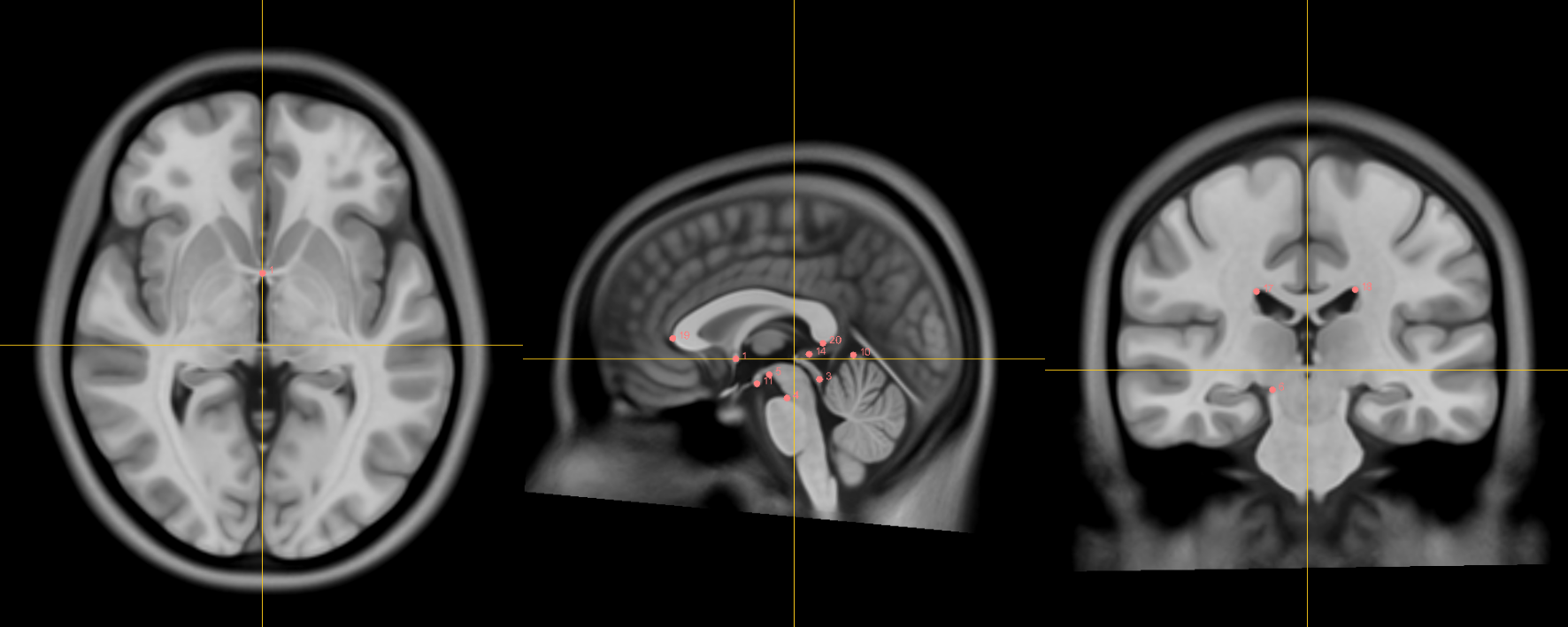 !The posterior commissure.