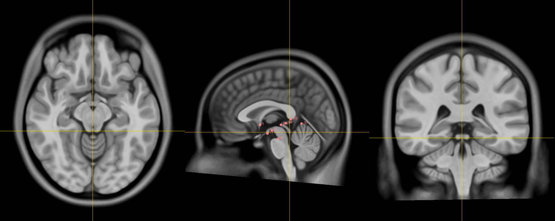 !The infracollicular sulcus.